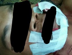 Sama’udin Melerai, Warga Montorna Dianiaya  Mulut Diiris Dengan Pisau
